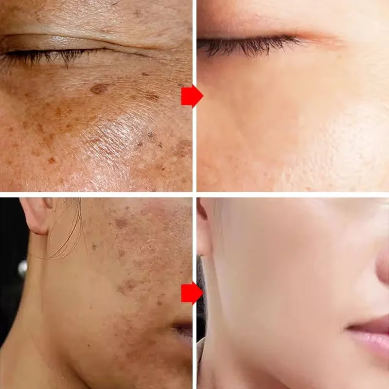 Nicotinamide Whitening Freckles Face Cream Remove Melasma Dark Spots Corrector Fade Melanin Acne Anti-Aging Brighten Skin Care