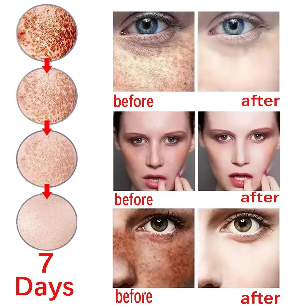 Nicotinamide Whitening Freckles Face Cream Remove Melasma Dark Spots Corrector Fade Melanin Acne Anti-Aging Brighten Skin Care